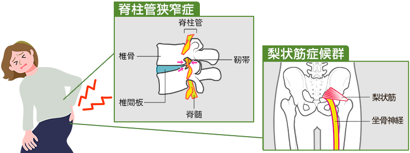 脊柱管狭窄症、梨状筋症候群のイメージ